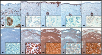 Immunohistochemistry in cutaneous adnexal carcinoma vs metastatic adenocarcinoma(Lee)-1