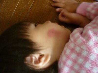 ブヨ ブト 子供がブユに刺され傷口が腫れ上がり痒い 2歳10ヶ月 ぼにょ朗育児日記