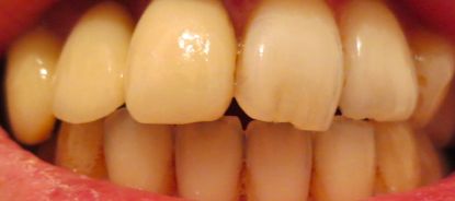 歯医者の結果