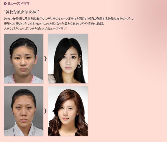シンデレラ整形外科の症例写真 コリアbeautyナビ 韓国での美容 整形 歯科 漢方 観光情報満載