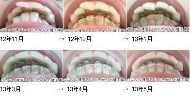 矯正歯科 変化写真まとめ 下から パニック障害 30代からの矯正歯科