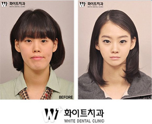 crazy_before_and_after_photos_of_korean_plastic_05.jpg