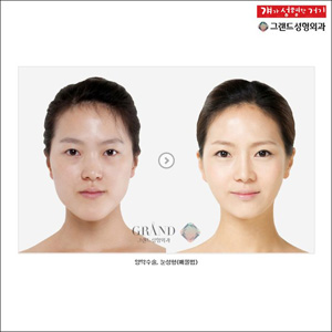 crazy_before_and_after_photos_of_korean_plastic_10.jpg