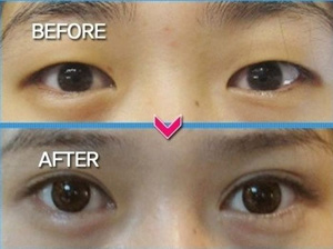 crazy_before_and_after_photos_of_korean_plastic_17.jpg