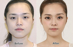 crazy_before_and_after_photos_of_korean_plastic_27.jpg