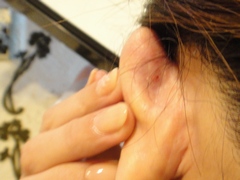 耳裏のトラブル続編(粉瘤ではなくにきび?)